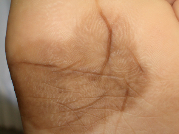 Figura 1 - Mcula pigmentada en la planta del pie izquierdo